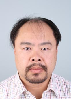 Before Hair Transplant&nbsp;Front